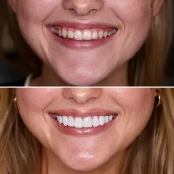 prodentim dental